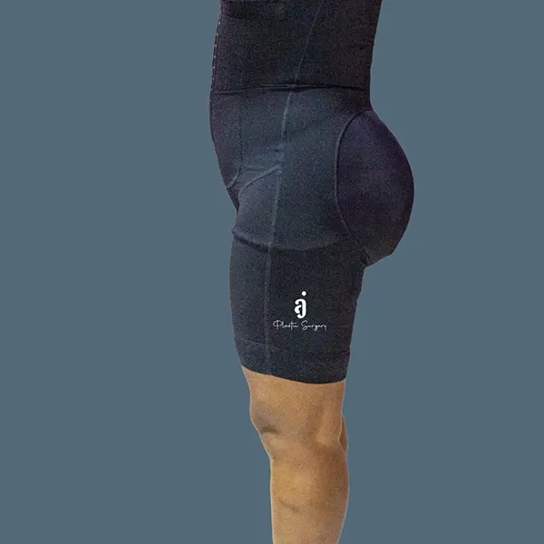 After tummy tuck case 01 alternate view at AJ Plastic Surgery Centre