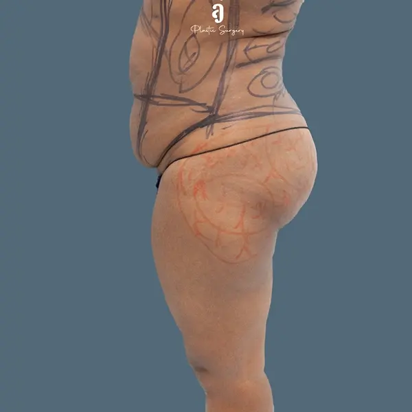 Before tummy tuck case 01 alternate view at AJ Plastic Surgery Centre