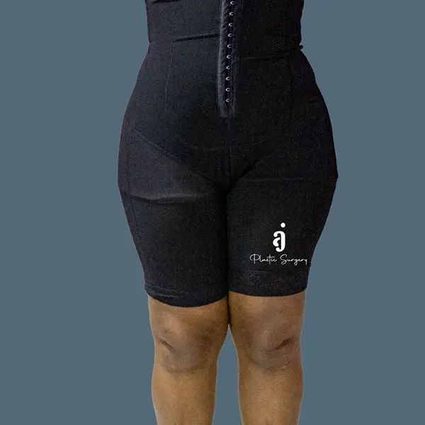 After tummy tuck case 01 front view at AJ Plastic Surgery Centre