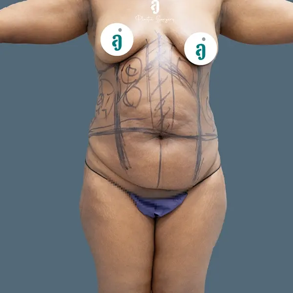 Before tummy tuck case 01 front view at AJ Plastic Surgery Centre