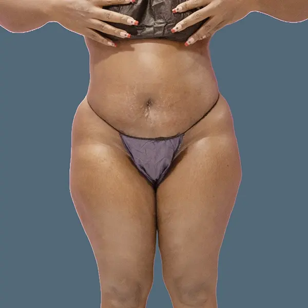After tummy tuck case 02 front view at AJ Plastic Surgery Centre