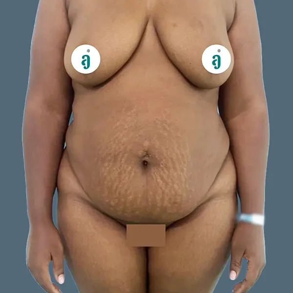 Before tummy tuck case 02 front view at AJ Plastic Surgery Centre