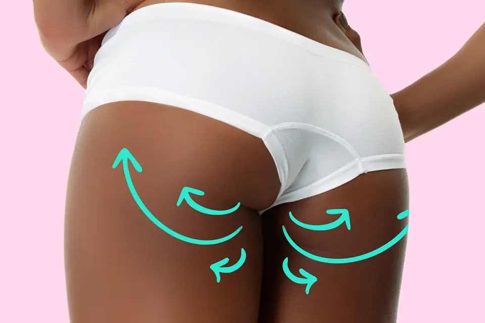 Brazilian butt lift in Kenya consultation for fat transfer and body contouring planning