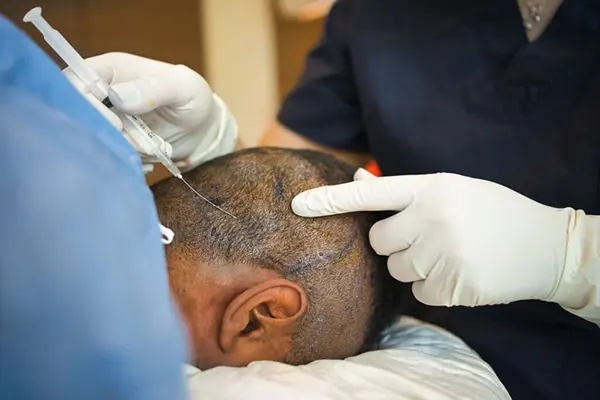 Hair transplant in Kenya consultation for hairline and hair density concerns