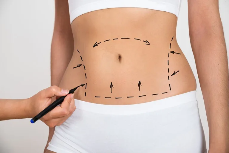 Liposuction in Kenya consultation and body contouring planning at AJ Plastic Surgery Centre