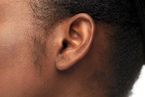 Otoplasty in Kenya consultation for ear reshaping and prominent ear concerns