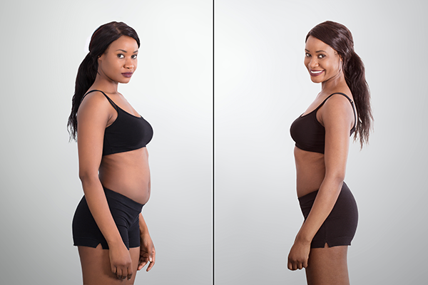 Achieve a flatter, toned tummy with expert tummy tuck surgery in Kenya. Our skilled surgeons provide safe and effective procedures.