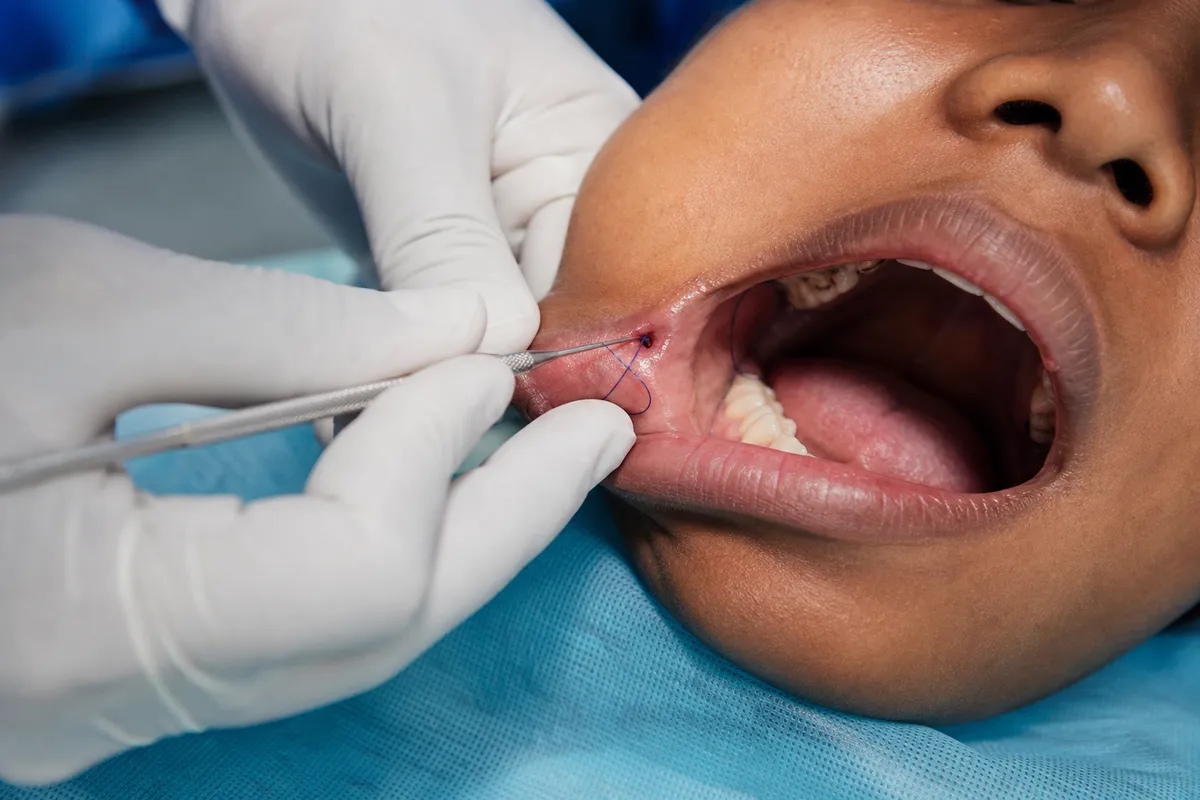A Kenyan surgeon’s gloved hands perform minimally invasive dimple creation surgery inside a patient's mouth with a fine surgical instrument focusing on the precise area beneath the cheek lining.