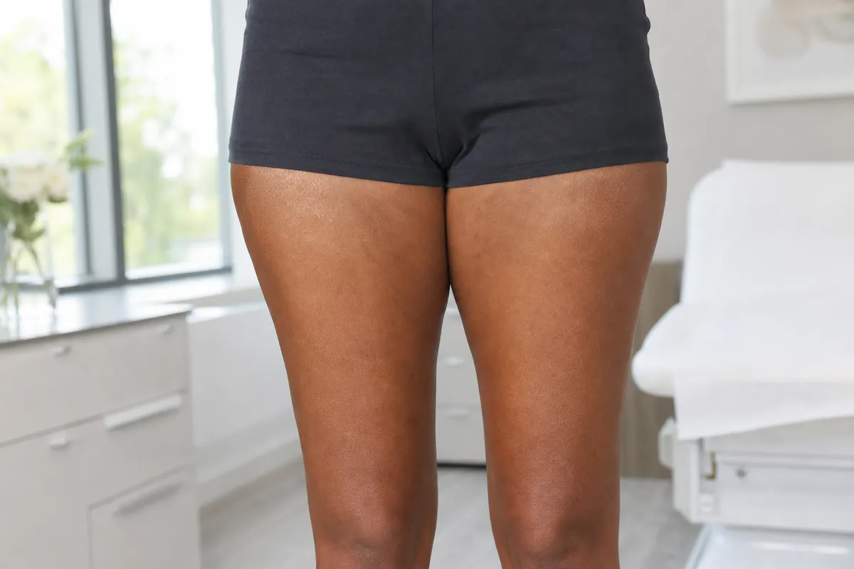 Waist-to-knee view of a Kenyan woman in shorts showing smooth, firm upper thighs in a softly lit clinic recovery room.