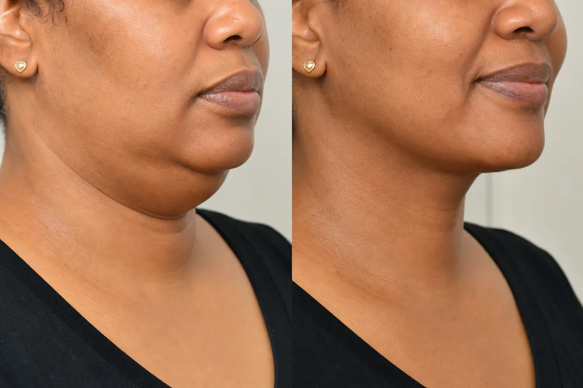 Side-by-side close-up of a Kenyan woman’s lower face and neck before and after neck liposuction, highlighting submental fullness on the left and a defined jawline on the right.