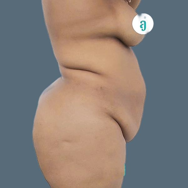 Before body contouring case 02 side view at AJ Plastic Surgery Centre