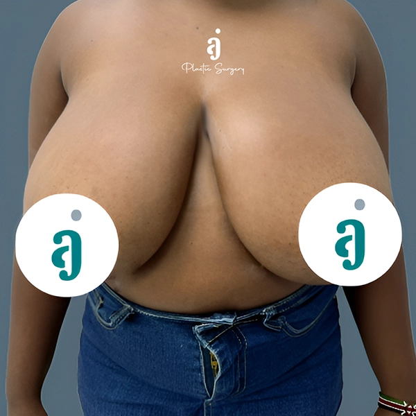 Before breast reduction case 03 front view at AJ Plastic Surgery Centre