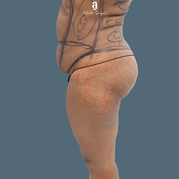 Before tummy tuck case 01 alternate view at AJ Plastic Surgery Centre